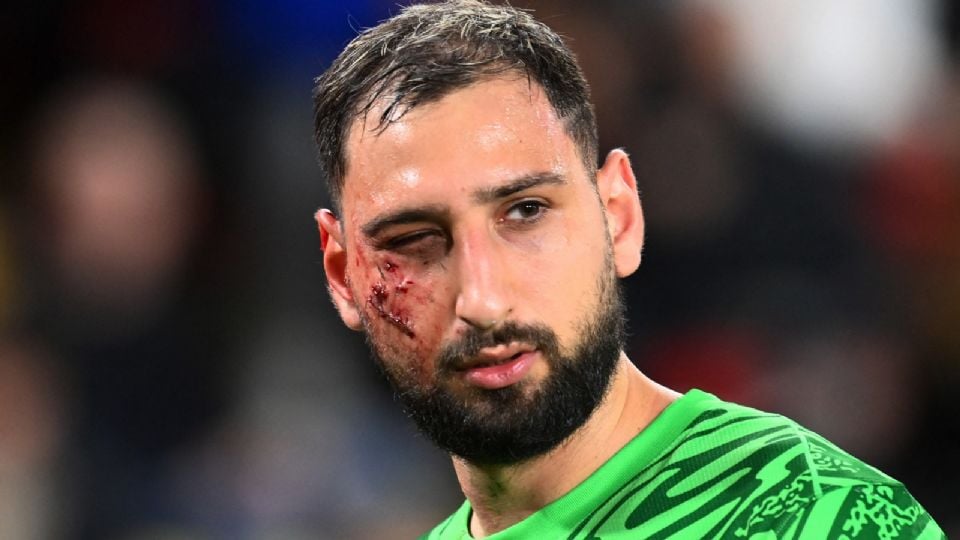 Donnarumma, con las heridas en su rostro.