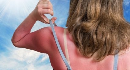 Diseñan tecnología para prevenir las quemaduras solares que "rebasan" al bloqueador